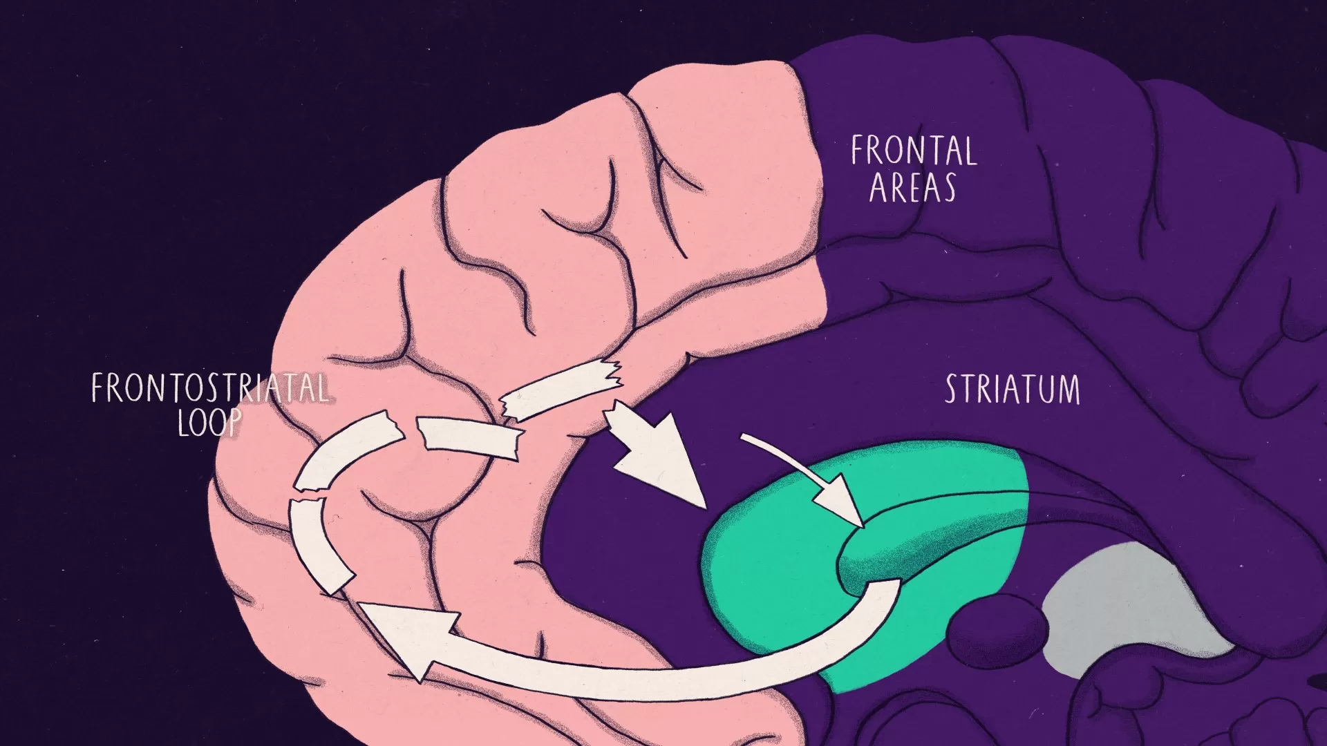 A brain with frontal areas and the striatum highlighted in different colours. The arrows between them, which depict frontostriatal loops, are broken up.